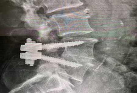 DiFusion Technologies: Future-Proofing Biomedical Implants