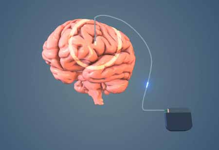 Exploring Vagus Nerve Stimulation: A Breakthrough in Neurological Treatment